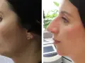 Czy aparat zmieni Twoją twarz? Rysy, profil, broda po leczeniu.