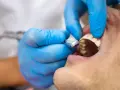 Dentysta w niebieskich rękawiczkach używa wiertła stomatologicznego. Decyzja, kiedy plomba a kiedy leczenie kanałowe, zależy od stanu zęba.