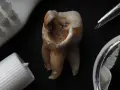 Zniszczony ząb z widoczną próchnicą przy dziąśle, obok szczoteczki i pasty do zębów.