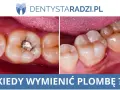 Przed i po: ząb z plombą i ząb po usunięciu próchnicy wtórnej. Czas na wymianę plomby?