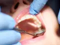 Dentysta bada zęby, szukając objawów próchnicy wtórnej. Widoczne są białe zęby i różowe dziąsła.