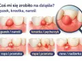 Ropa nad zębem może przybierać formę guzka, krostki lub rany. Ilustracje pokazują różne stadia problemu.