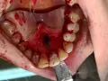 Po zabiegu chirurgicznym widoczna jest rana na podniebieniu, gdzie usunięto torbiel. Krwawienie i szwy wskazują na niedawne leczenie.
