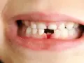 Wypadanie zębów mlecznych: objawy, kalendarz i kiedy do dentysty?