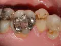 Zęby z widocznymi, metalicznymi czarne plomby, niektóre popękane. Widać też naturalne przebarwienia na pozostałych zębach.