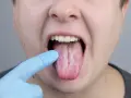Biały nalot na języku, wskazujący na drożdżaki w jamie ustnej.