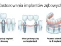 Ilustracja pokazuje, jak implanty zębowe pomagają ludziom bez zębów odzyskać uśmiech: pojedynczy implant z koroną, most protetyczny i proteza overdenture.
