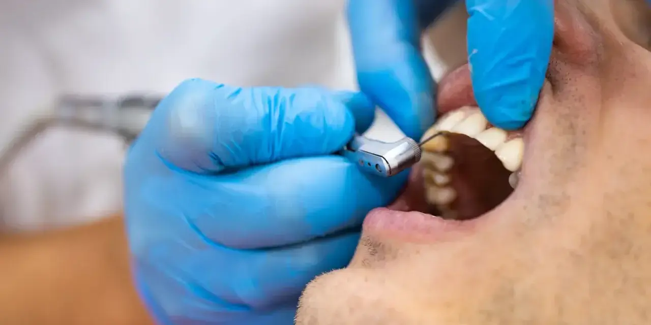 Dentysta w niebieskich rękawiczkach używa wiertła stomatologicznego. Decyzja, kiedy plomba a kiedy leczenie kanałowe, zależy od stanu zęba.