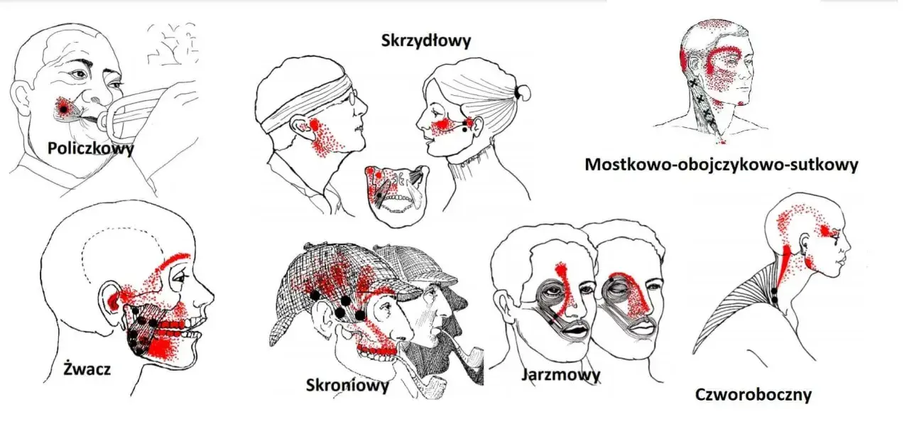 Ilustracje pokazują punkty bólu związane z zapaleniem stawu skroniowo-żuchwowego, obejmujące różne obszary głowy i szyi.