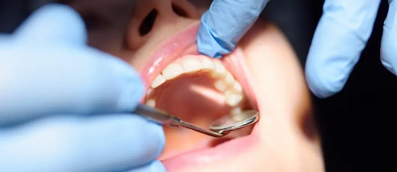Dentysta bada zęby, szukając objawów próchnicy wtórnej. Widoczne są białe zęby i różowe dziąsła.