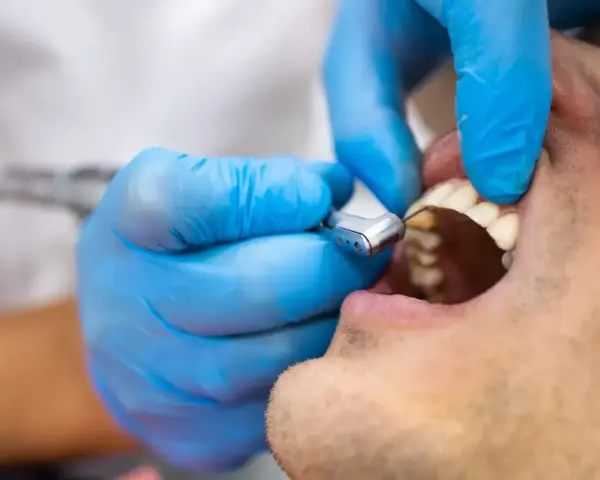 Dentysta w niebieskich rękawiczkach używa wiertła stomatologicznego. Decyzja, kiedy plomba a kiedy leczenie kanałowe, zależy od stanu zęba.