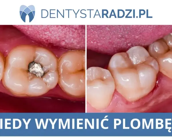Przed i po: ząb z plombą i ząb po usunięciu próchnicy wtórnej. Czas na wymianę plomby?