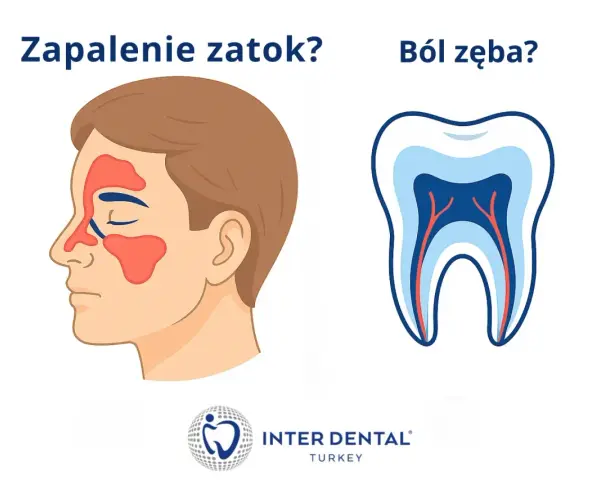 Zapalenie zatok czy ból zęba? Ilustracja pokazuje twarz z zaznaczonymi zatokami i przekrój zęba, sugerując związek między nimi.