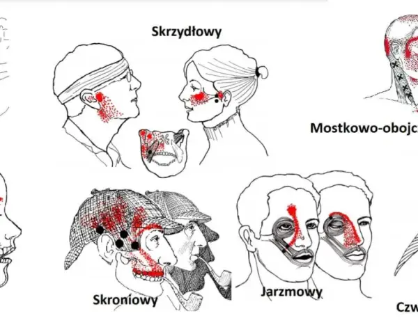 Ilustracje pokazują punkty bólu związane z zapaleniem stawu skroniowo-żuchwowego, obejmujące różne obszary głowy i szyi.