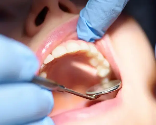 Dentysta bada zęby, szukając objawów próchnicy wtórnej. Widoczne są białe zęby i różowe dziąsła.