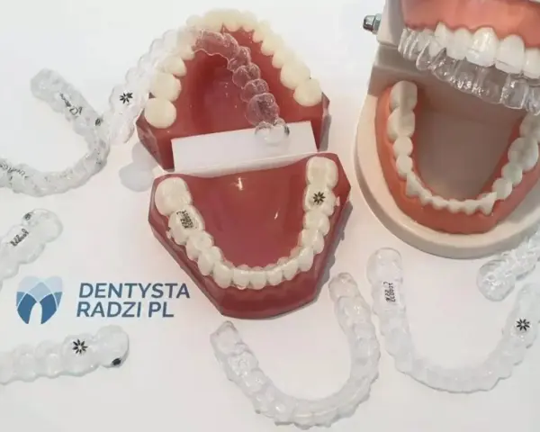 Aparat ortodontyczny tylko na górę? Kiedy tak, a kiedy to ryzyko?
