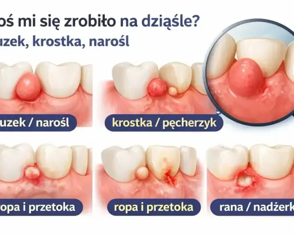 Ilustracja pokazuje różne zmiany na dziąśle: guzek, krostkę, ropę i przetokę. Domowe sposoby na przetokę zębową mogą pomóc złagodzić objawy.
