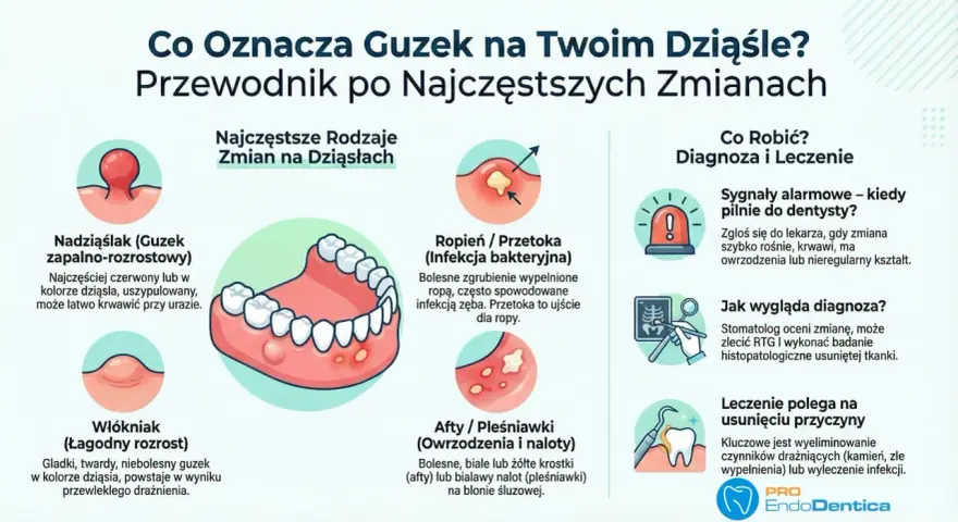 Ilustracja pokazuje ropień zęba, czyli bolesne zgrubienie na dziąśle wypełnione ropą, często spowodowane infekcją.