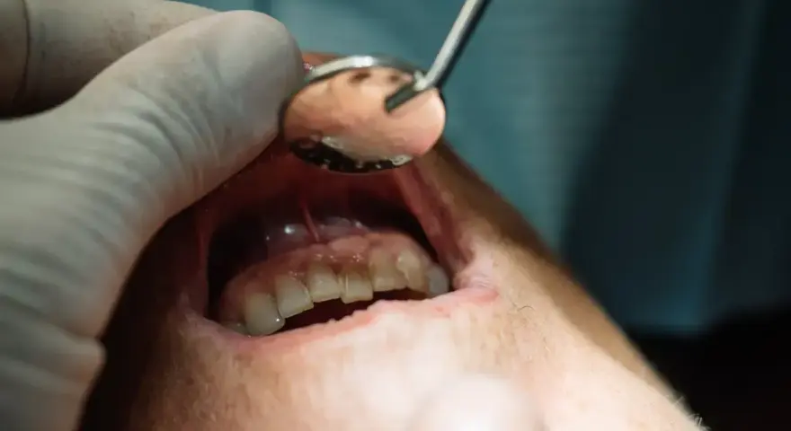 Dentysta bada jamę ustną, widoczny jest ropień przyzębia.