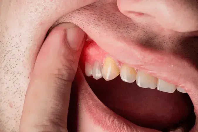 Zapalenie dziąseł? Skuteczne płukanki i kiedy do dentysty