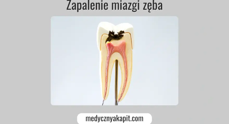 Model zęba ukazujący próchnicę i zapalenie miazgi.