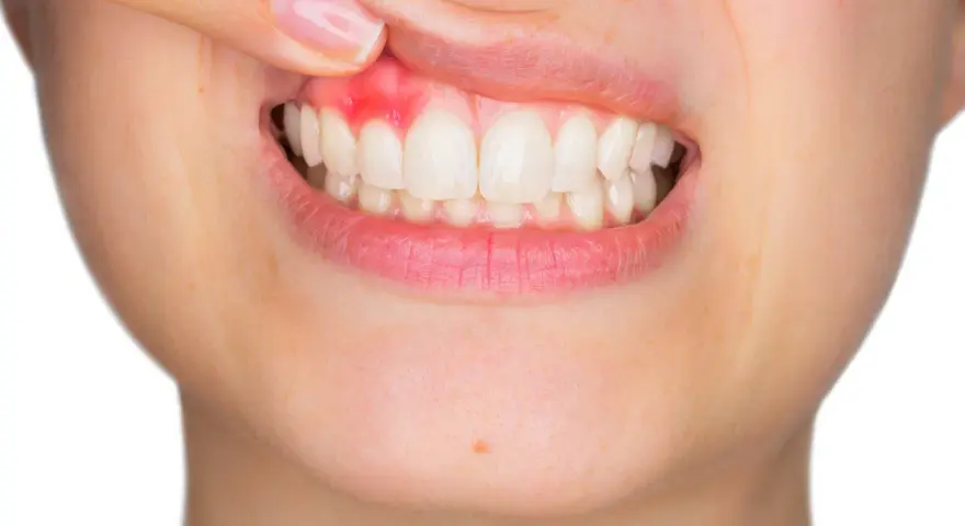 Jedzenie w dziąśle? Skuteczne metody i kiedy iść do dentysty