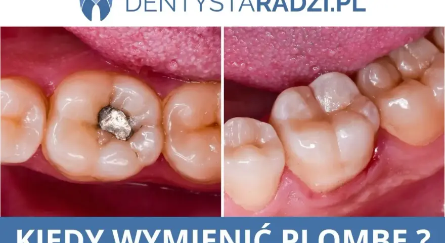 Porównanie zęba przed i po plombowaniu. Widoczny ubytek wypełniony amalgamatem i zdrowy ząb po zabiegu.
