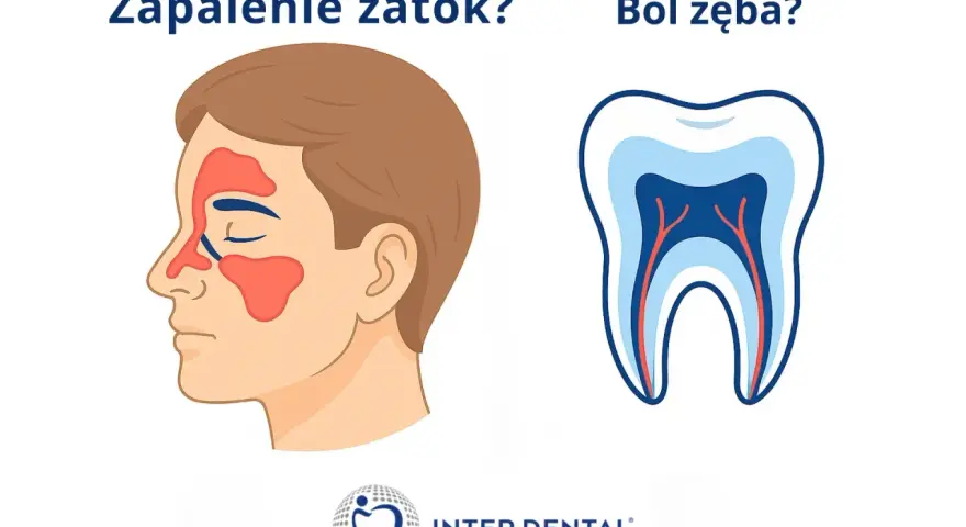 Zapalenie zatok czy ból zęba? Ilustracja pokazuje twarz z zaznaczonymi zatokami i przekrój zęba, sugerując związek między nimi.