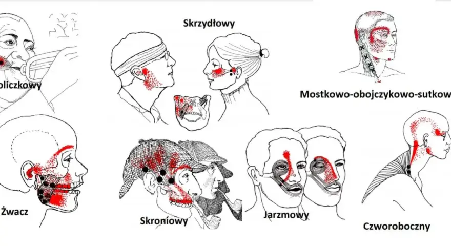 Ilustracje pokazują punkty bólu związane z zapaleniem stawu skroniowo-żuchwowego, obejmujące różne obszary głowy i szyi.