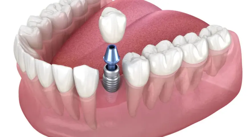 Brak piątki? Ile kosztuje implant, most, proteza? Porównanie cen