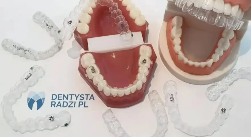 Aparat ortodontyczny tylko na górę? Kiedy tak, a kiedy to ryzyko?