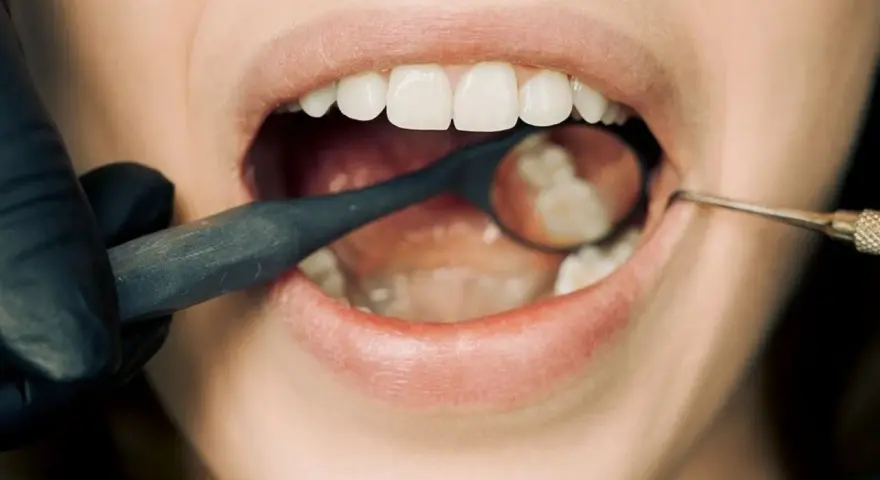 Dentysta bada ząb z plombą. Czy wiesz, plomba co to jest? To wypełnienie ubytku w zębie.