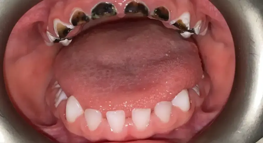 Zniszczone zęby, czarne plamy. Jak pozbyć się próchnicy domowymi sposobami zapytaj dentystę.