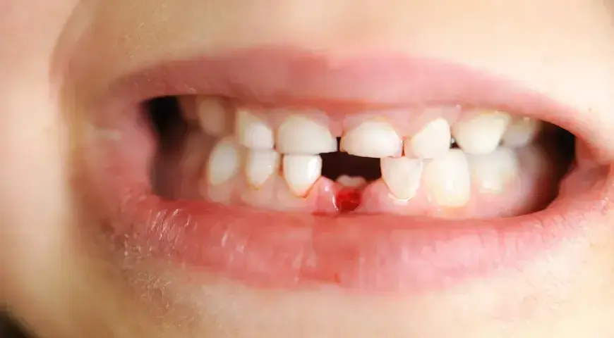 Wypadanie zębów mlecznych: objawy, kalendarz i kiedy do dentysty?