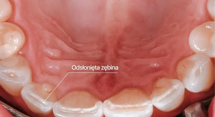 Odsłonięta zębina na zębach, objaw bruksizmu. Leczenie może obejmować szyny relaksacyjne.