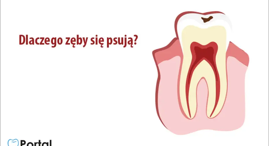 Od czego psują się zęby? Odkryj prawdziwe przyczyny i chroń uśmiech