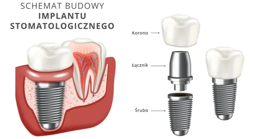 Schemat budowy implantu stomatologicznego: korona, łącznik i śruba.