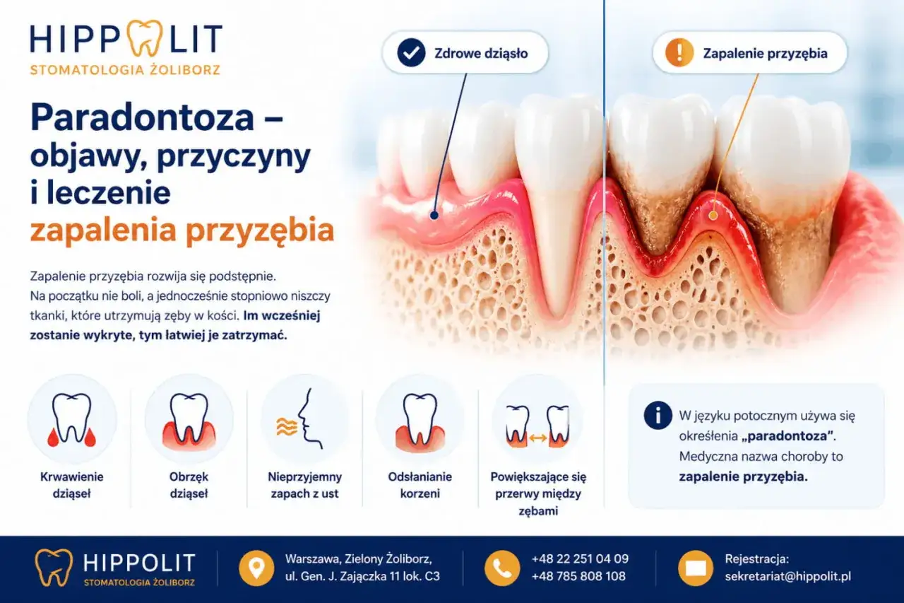 Zapalenie przyzębia, czyli paradontoza, powoduje ruszający się ząb. Obraz pokazuje zdrowe dziąsło i postępującą chorobę.