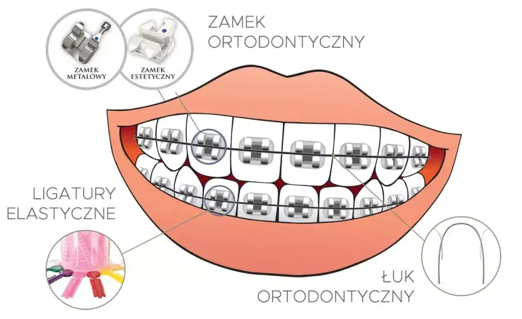 Etapy leczenia ortodontycznego infografika